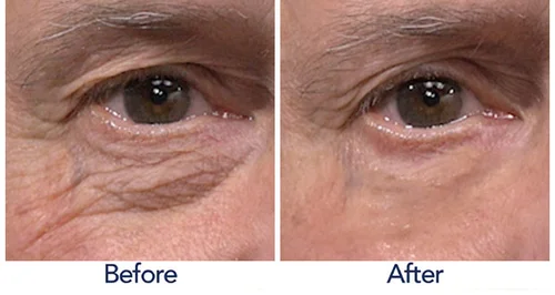 after plexaderm